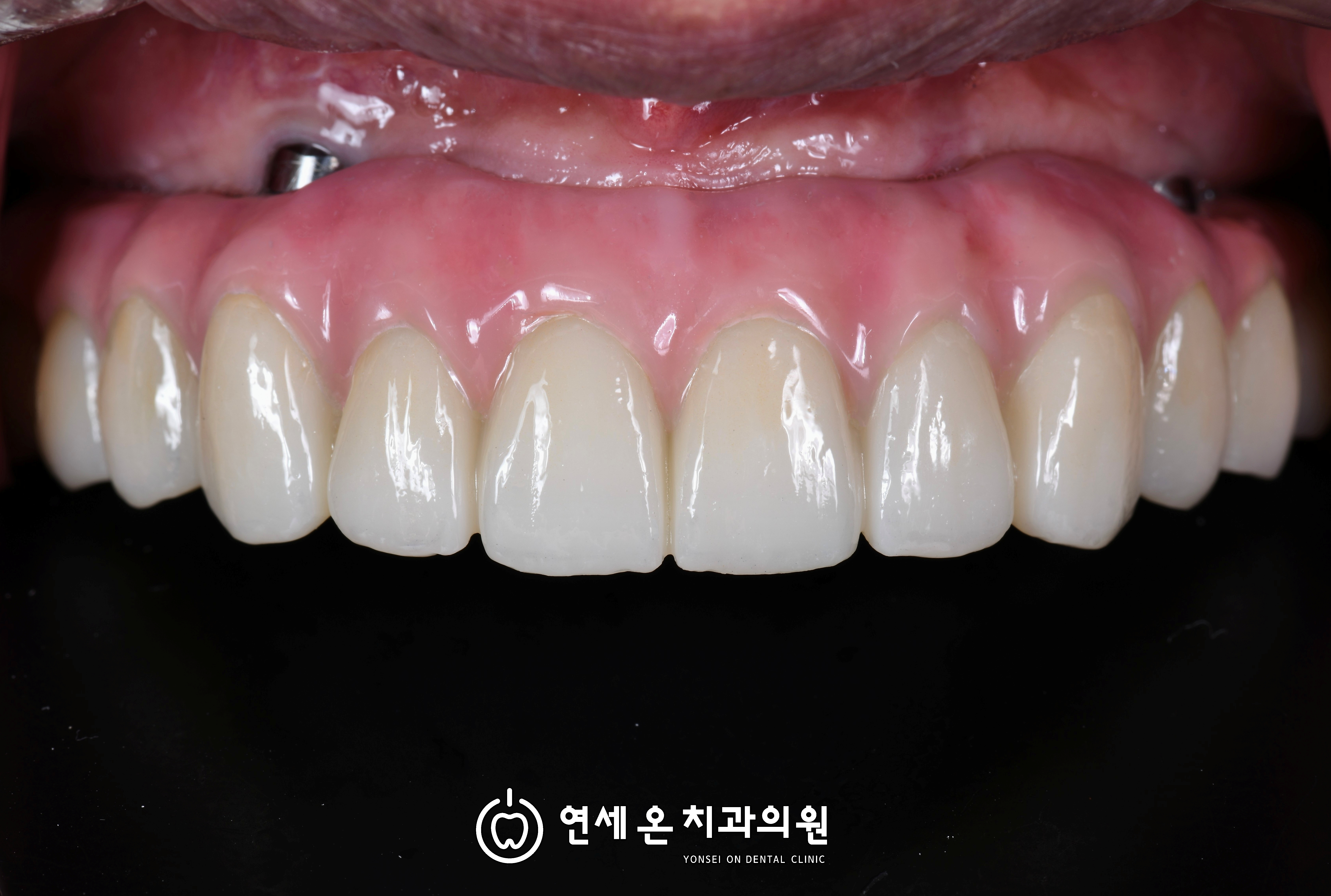 "이제 틀니말고는 방법이 없나"라고 생각하기 전에 - 올온엑스전체임플란트 — 김경희 대표원장