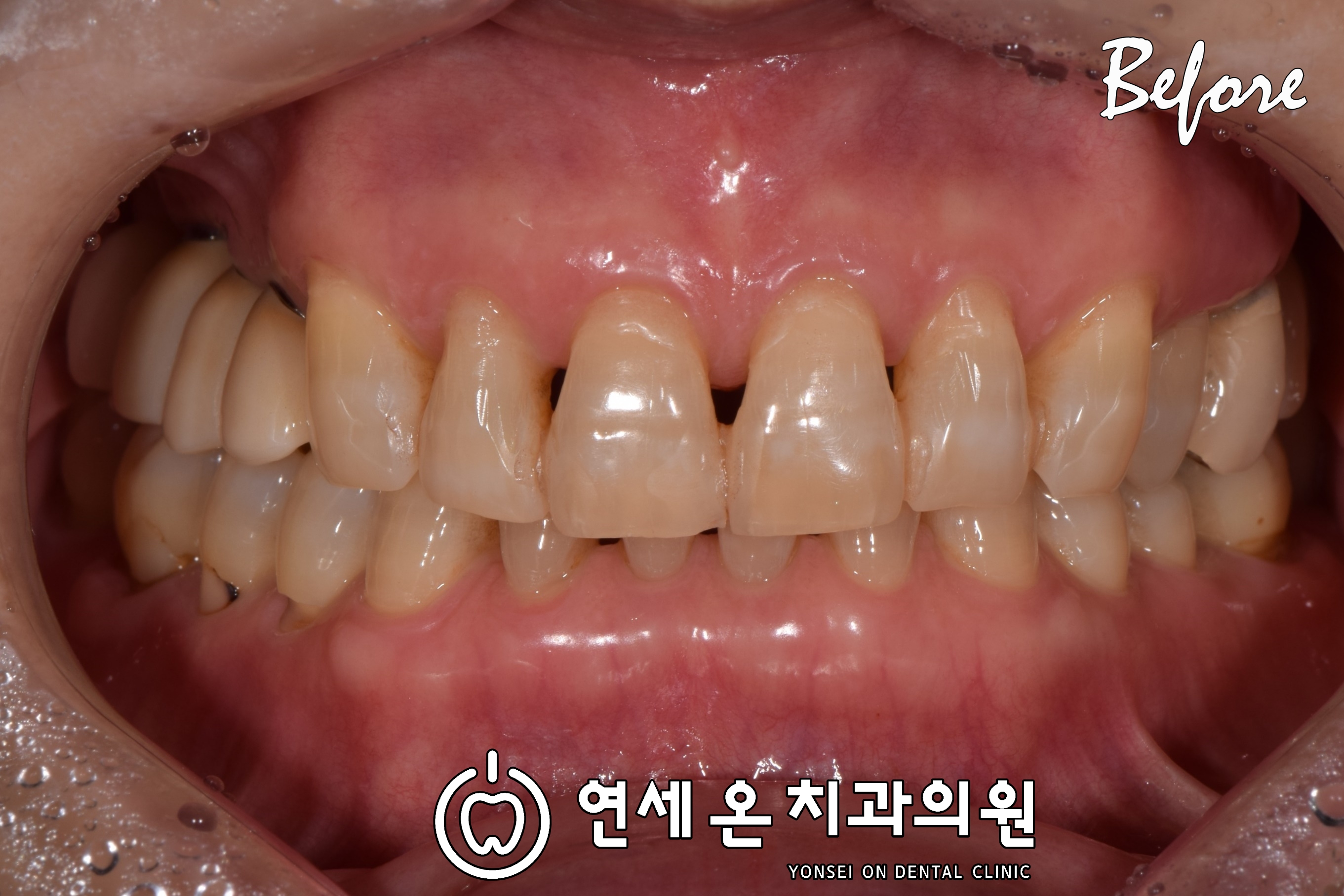 60대여성 - 블랙트라이앵글 레진수복