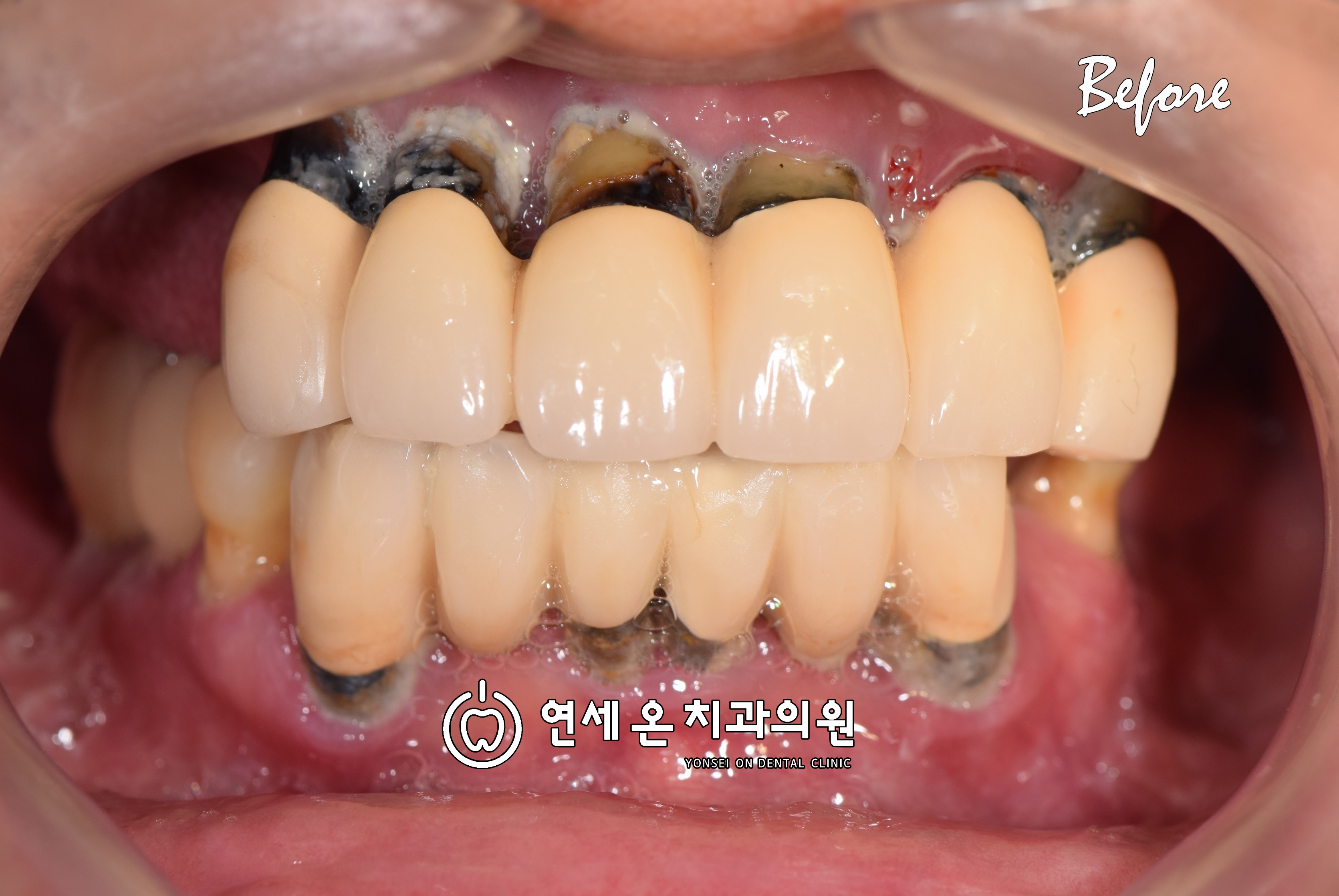 60대 남성-올온엑스 전체임플란트