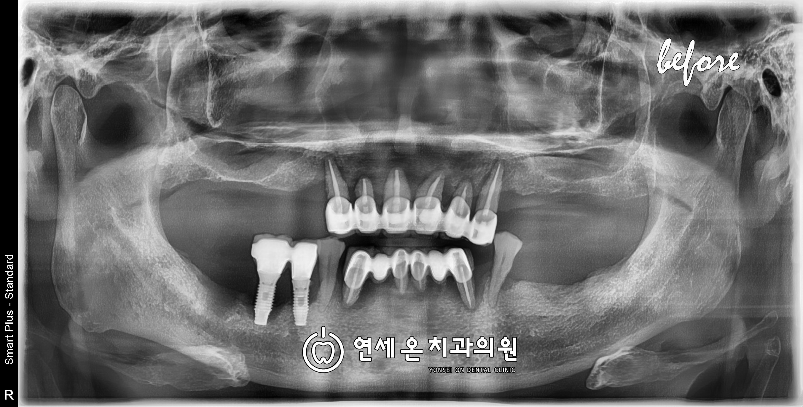 파노라마 치료 전