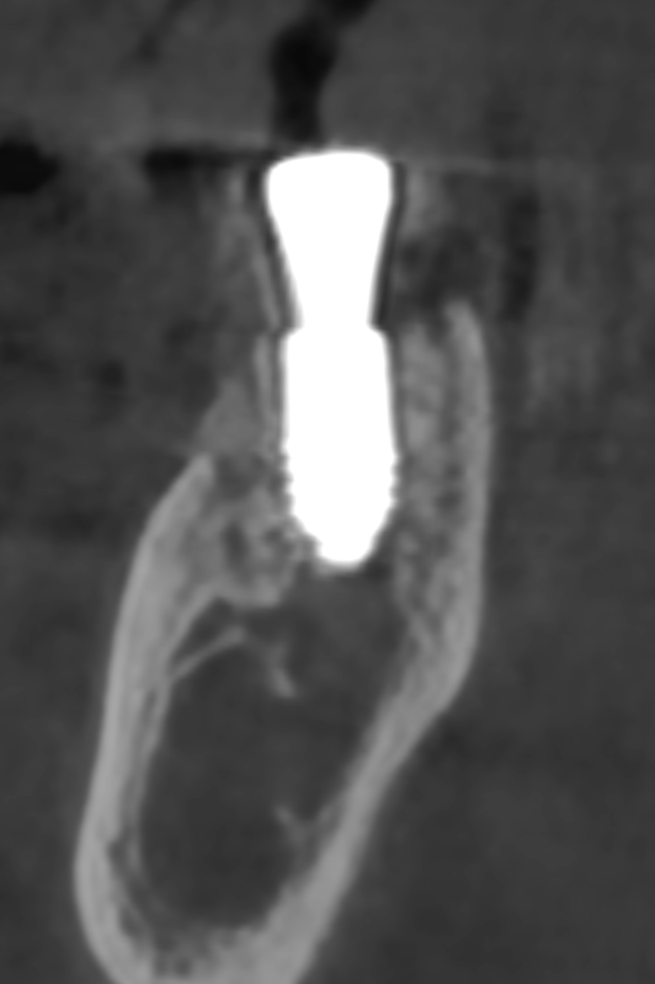 megagen BD cuff implant