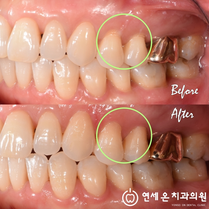 시린 이, 떼운 곳이 자꾸 떨어지다면 - 치경부마모증과 본드필이야기 — 김경희 대표원장