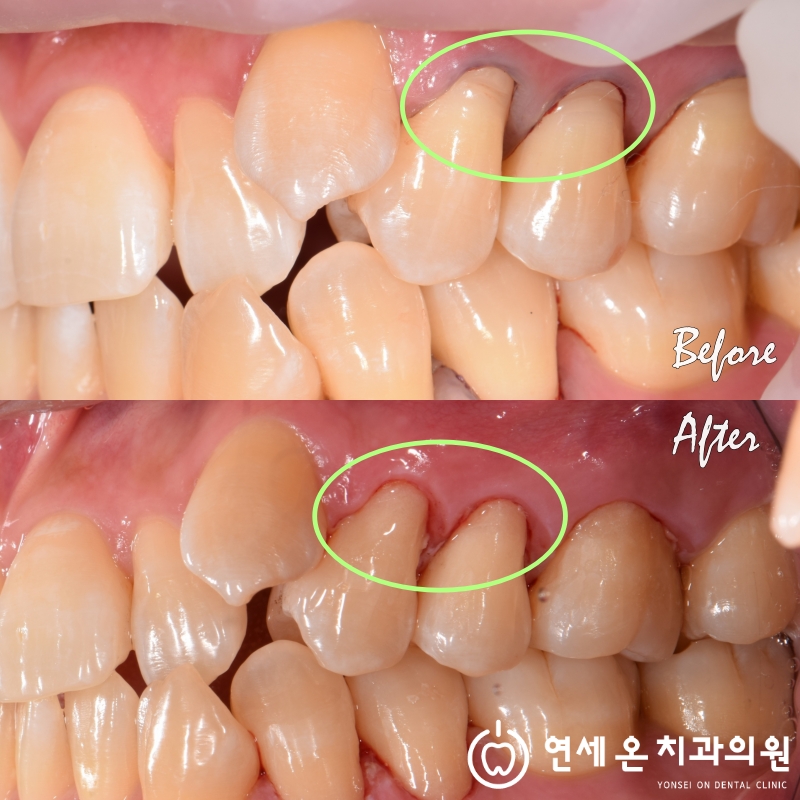 abfraction을 Bondfil로 수복한사진