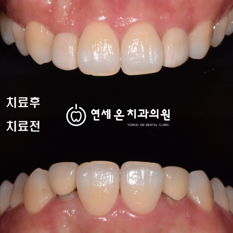 어르신 라미네이트, 나이보다 자연스러움이 우선입니다. — 김경희 대표원장
