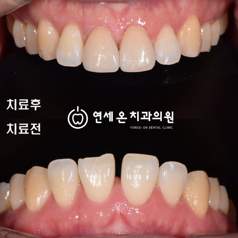 중장년라미네이트