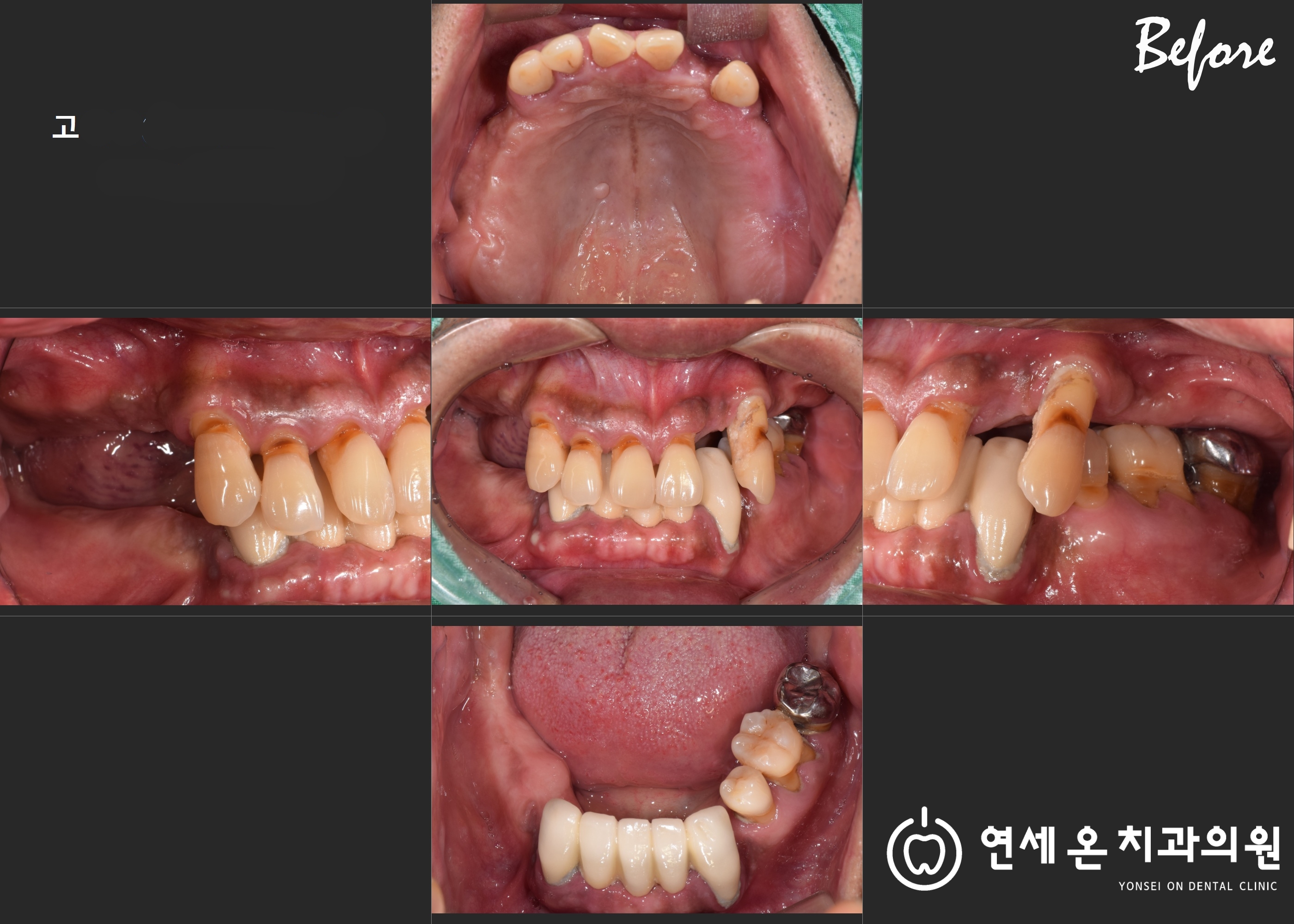 구내 사진 치료 전