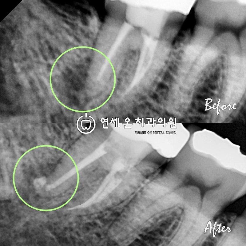 재신경치료re-RootCanalTreatment