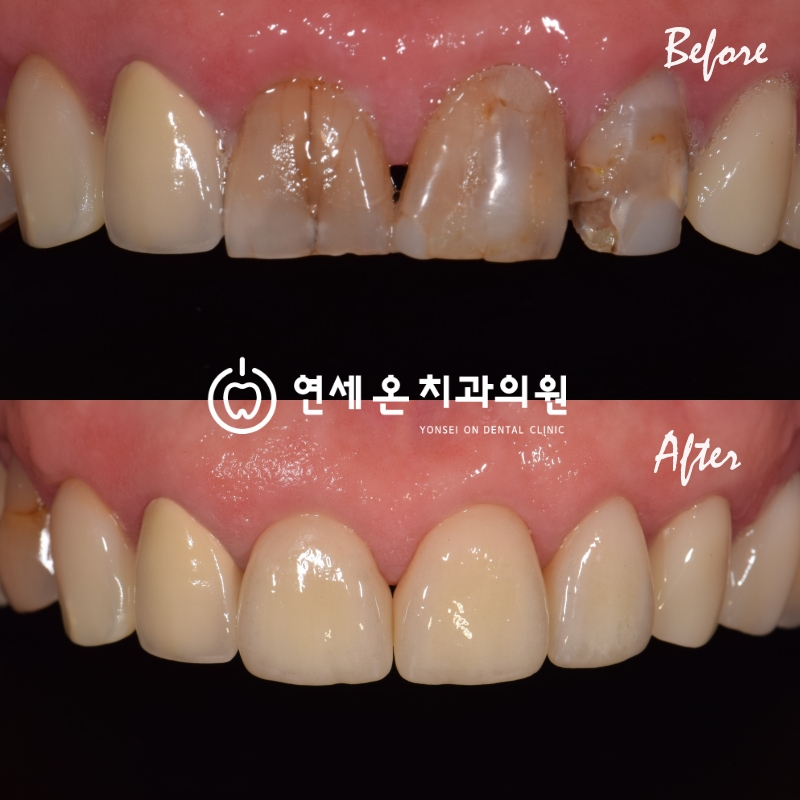 얼굴만 늙는게 아닙니다. 치아도 늙는다는 사실 알고 계셨나요? — 김경희 대표원장