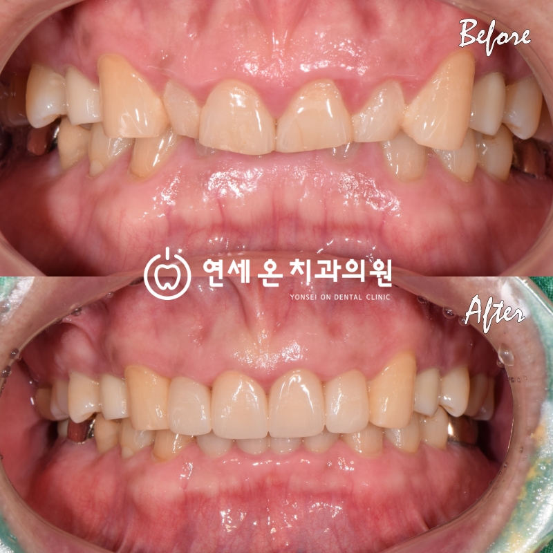60대남성의전치부심미보철풀지르코니아보철
