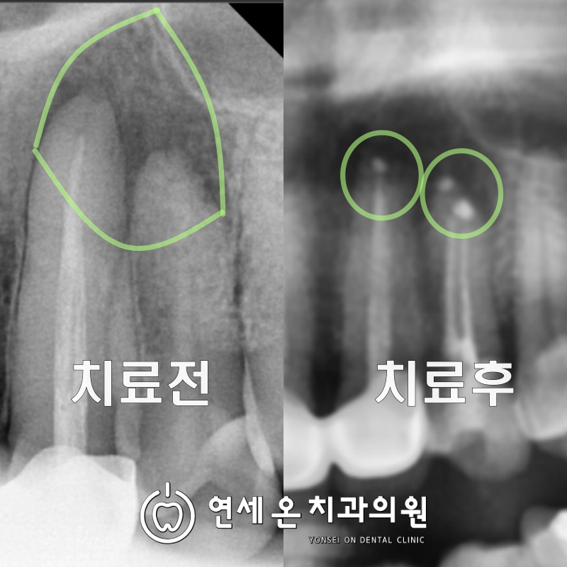 치근단절제술(Apicoectomy)치료전후