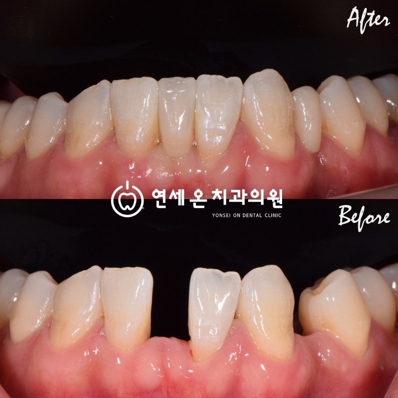 아랫니 1개가 없다면? 메릴랜드브릿지라는 선택지 — 김경희 대표원장