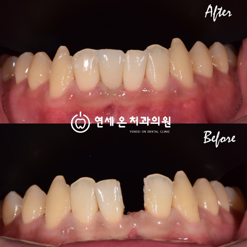 하악전치메릴랜드브릿지