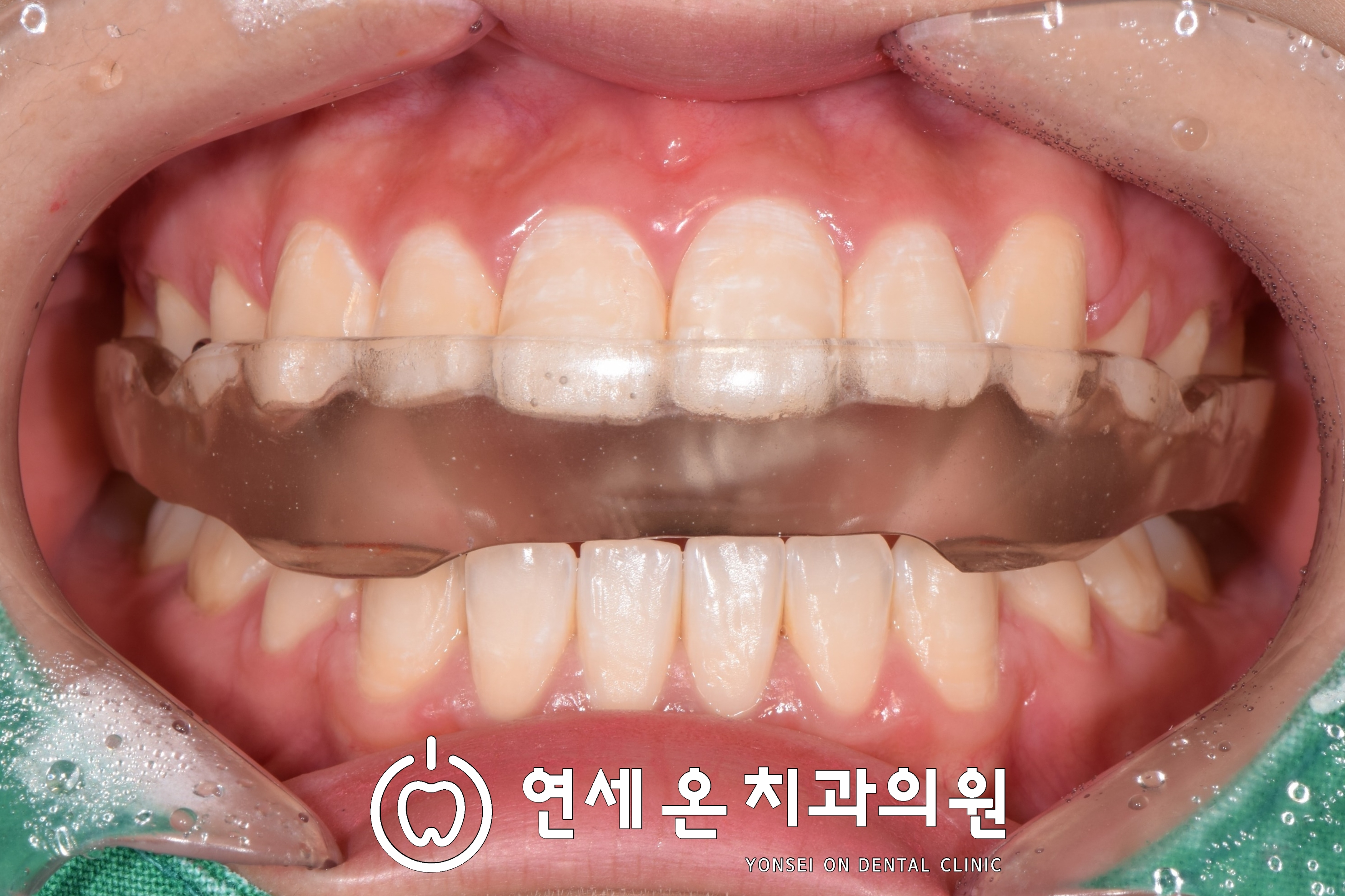 턱관절안정장치stabilizationsplint