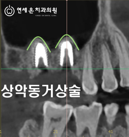 임플란트 전 상악동거상술, 꼭 필요한 경우와 주의사항 — 김경희 대표원장
