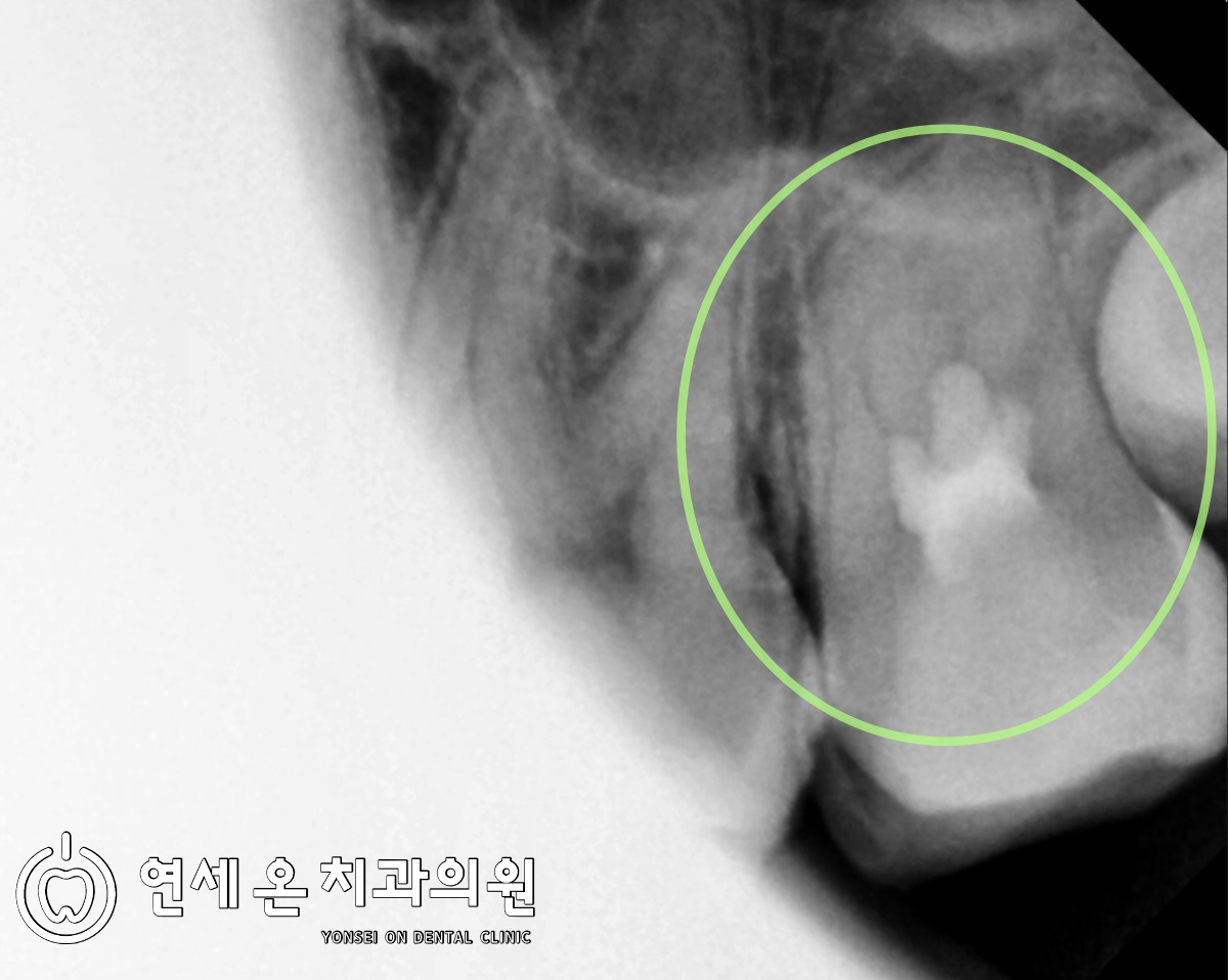 Vitalpulptherapy,생활치수치료