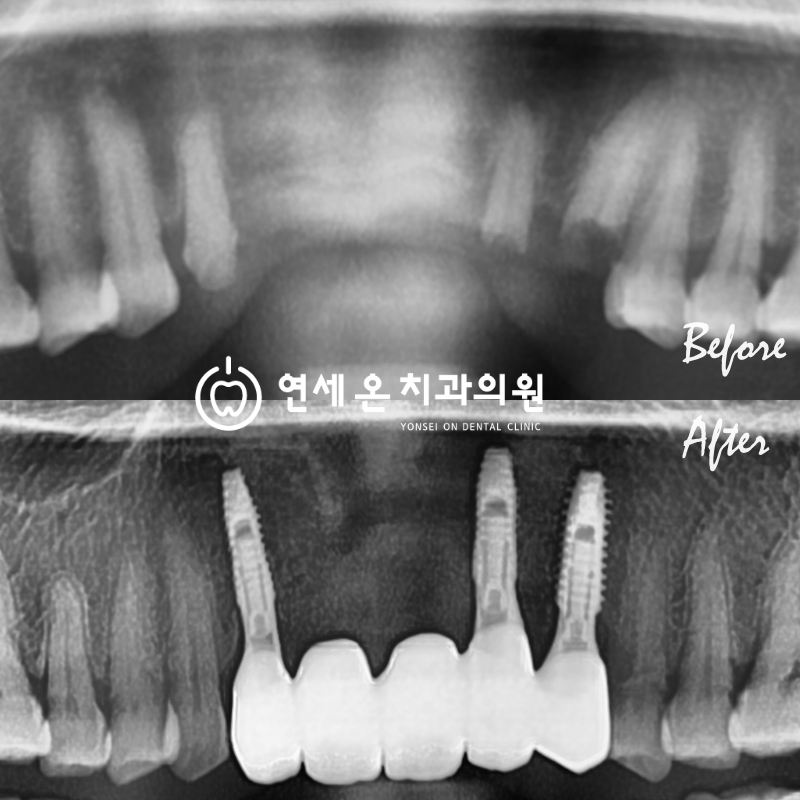 임플란트 치료기간, 골유착과 표면처리의 비밀 — 김경희 대표원장