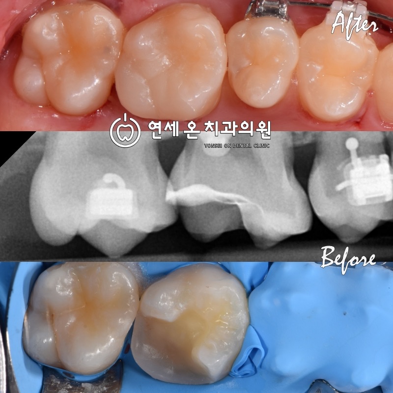 연세온치과 접착수복 실제 케이스 — 러버댐 방습 하 온레이로 손상 부위만 최소 삭제로 정밀 수복한 Before/After 및 방사선 사진