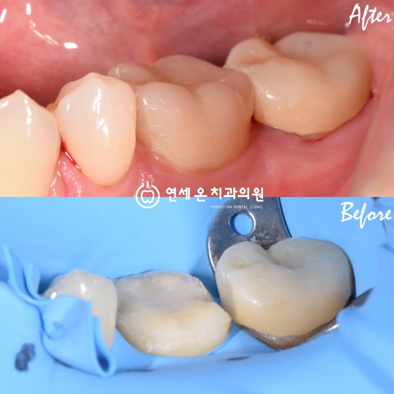 연세온치과 접착수복 실제 케이스 — 어금니 교두까지 덮는 오버레이로 자연치 형태를 보존 수복한 Before/After
