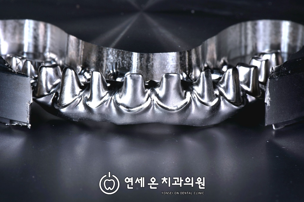 연세온치과에서 직접 제작한 All-on-X Ti-Thimble bar(티타늄 바) 실제 케이스 — 자연치 형태의 교합면을 정밀 가공한 고정성 보철 프레임